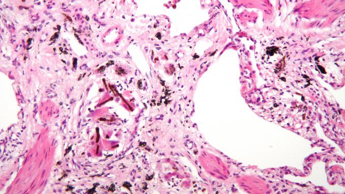 ¿Tienen los pacientes con asbestosis mayor riesgo de fallecer por covid?