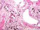 ¿Tienen los pacientes con asbestosis mayor riesgo de fallecer por covid?